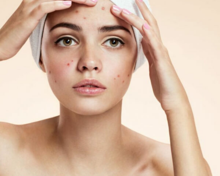 Tratamiento para el Acné Leve