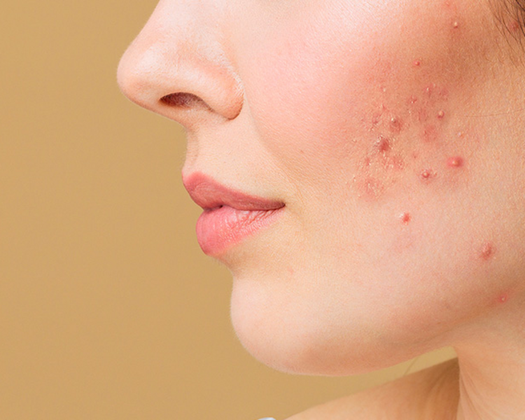 Tratamiento para el Acné Moderado