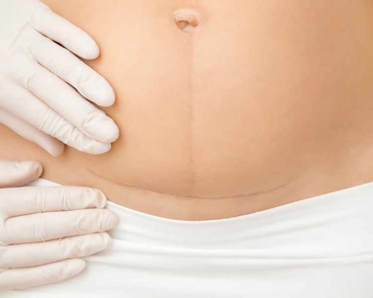 Post Parto - 10 sesiones