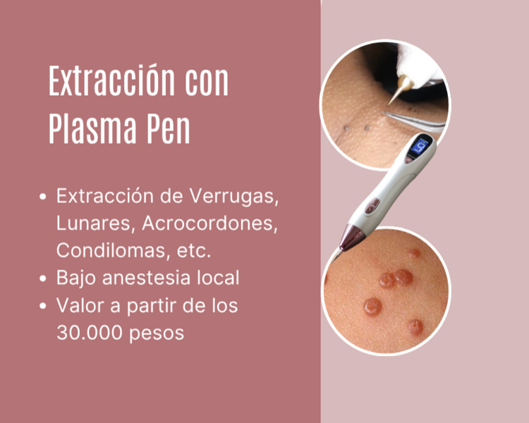 Extracción condilomas, acrocordones, lunares con Plasmapen