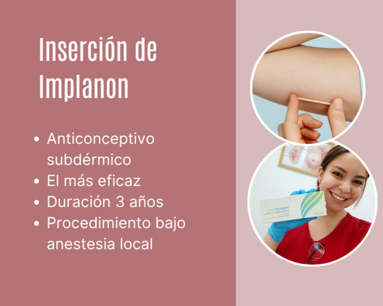 Inserción Implanon 