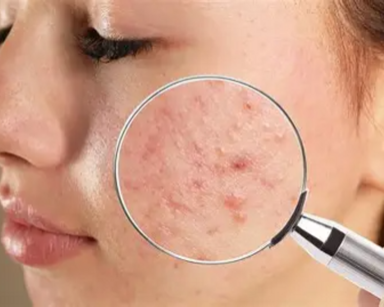 Limpieza Facial Adolescente 