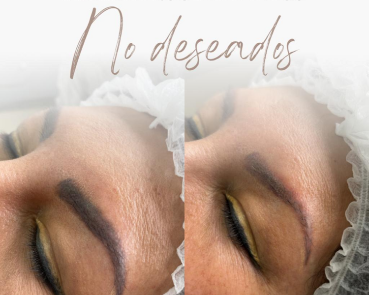Remocion de tatuaje en cejas