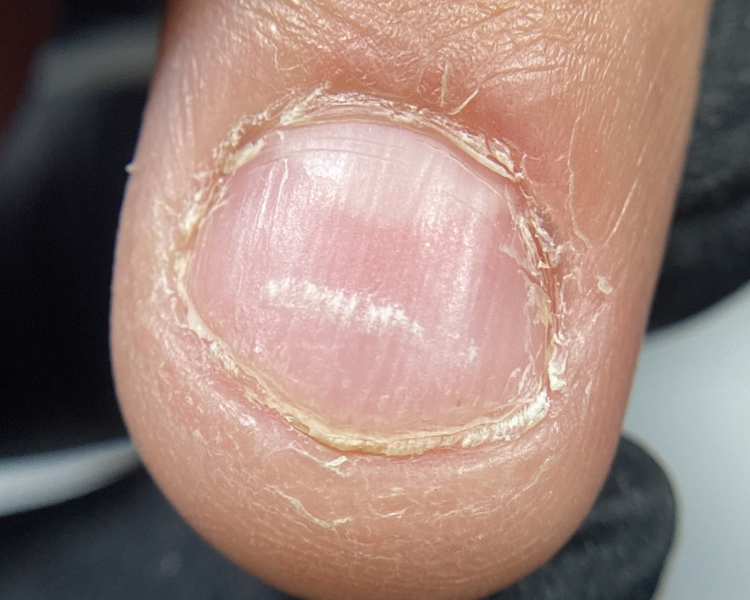 PACK Micro extensión onicofagia (uñas mordidas)