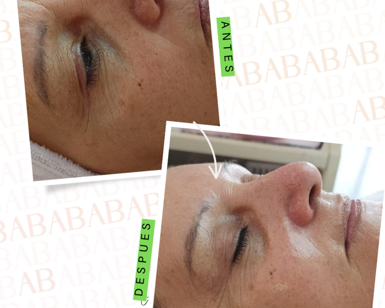 Facial: Limp profunda + PEELING