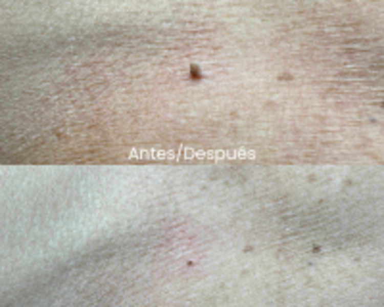 Eliminación de Acrocordones 