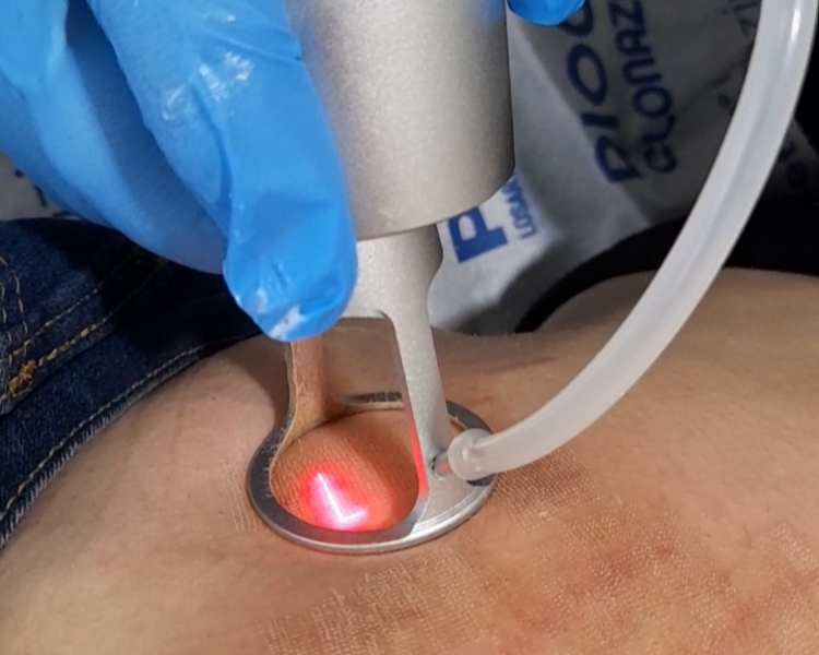 TratamientoLaser CO2