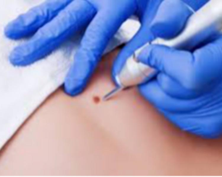 Fibroblast  Acrocordones