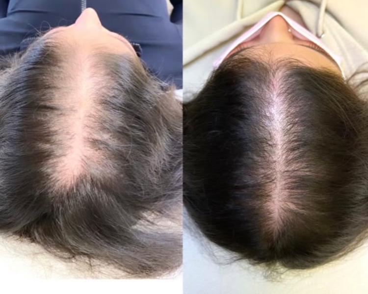 RECUPERACIÓN CAPILAR