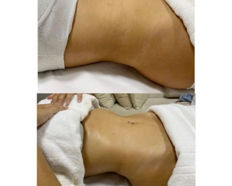 MASAJES POST QUIRÚRGICOS