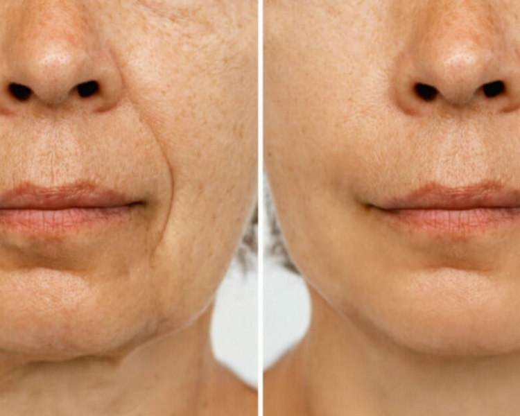 Ácido Hialurónico: Surcos Nasogenianos