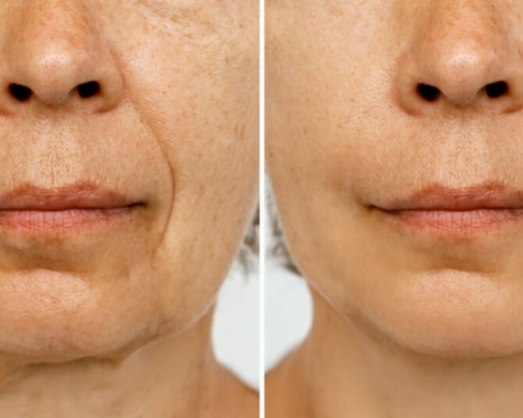 Ácido Hialurónico: Surcos Nasogenianos