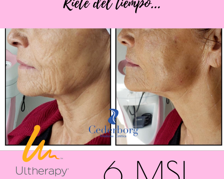 Ultherapy Tercio Inferior