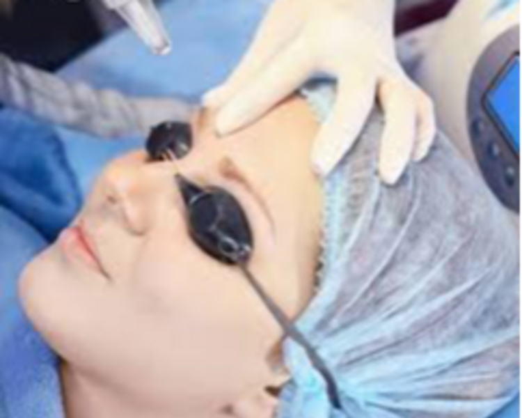 Despigmentacion Laser 3 Sesiones