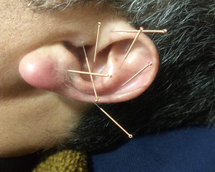 Auriculoterapia