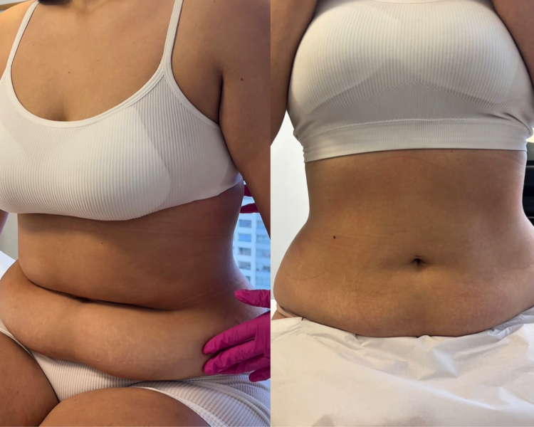 Criolipolisis Plana (todo abdomen) + 3 ems