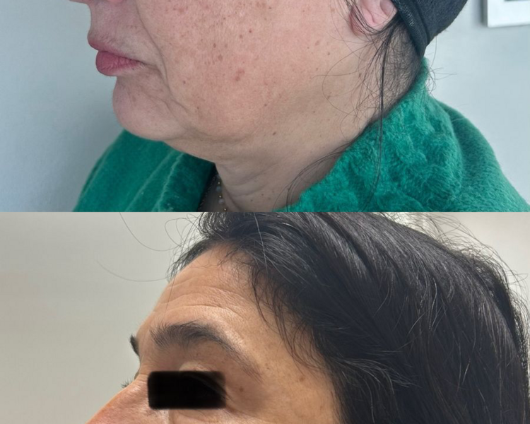 BIOESTIMULADOR SCULPTRA