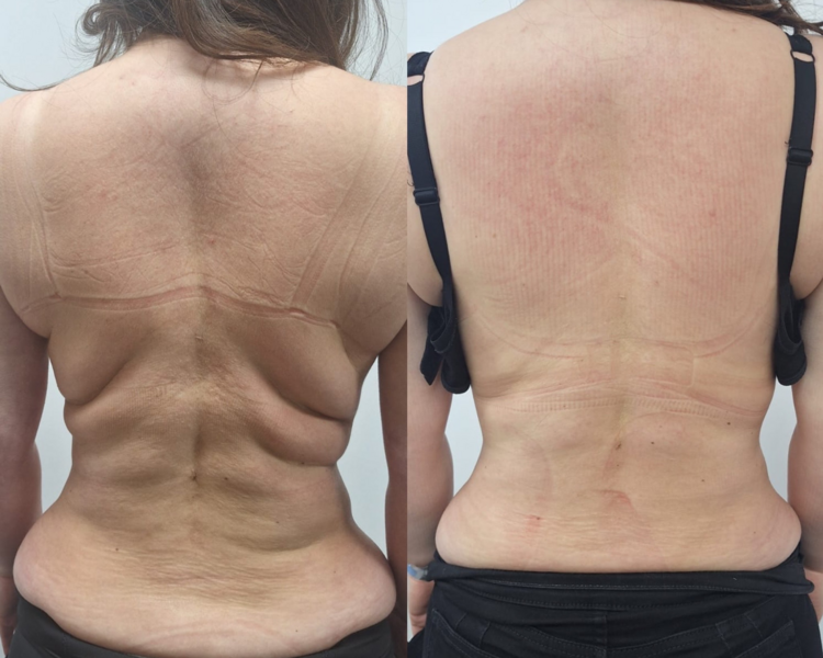 Criolipolisis Succión (abdomen alto y bajo) + 3 ems