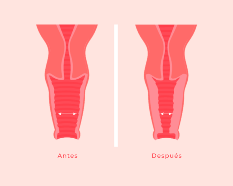 🩺Evaluación previa al tratamiento HIFU íntimo🩺