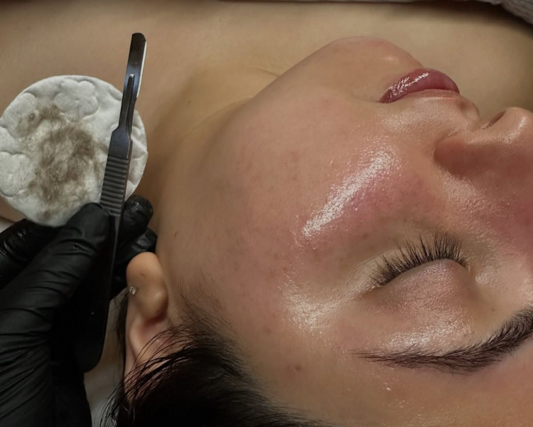Dermaplaning