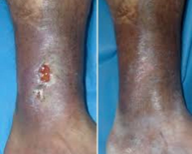 Curación Avanzada de Heridas (Pie Diabético- Ulceras Venosas y/o Arteriales)