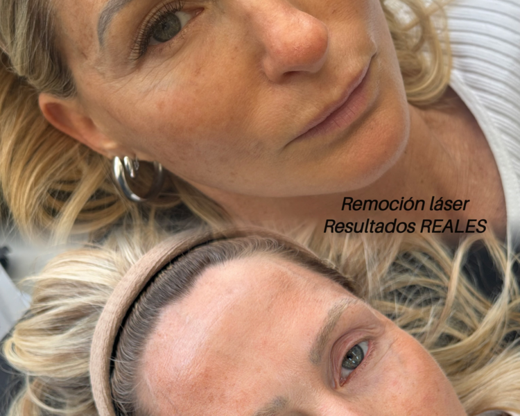 Remoción micropigmentacion CEJAS 