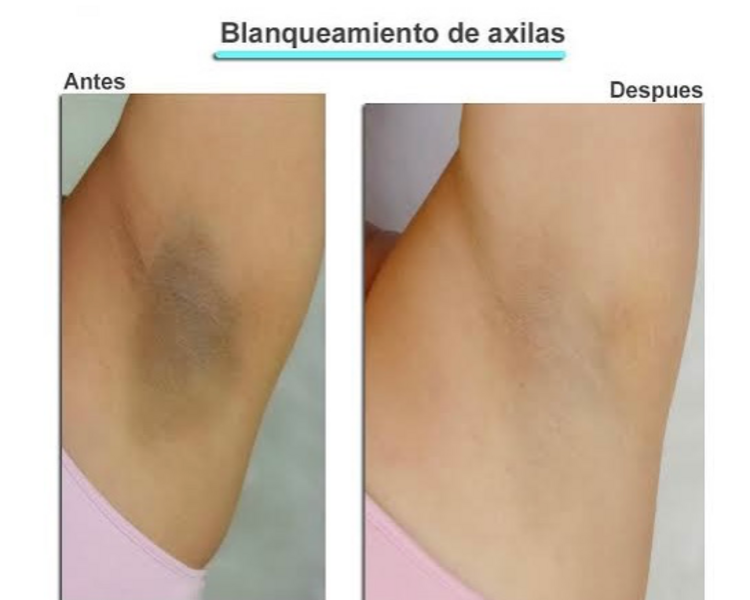DESPIGMENTACIÓN DE AXILAS 