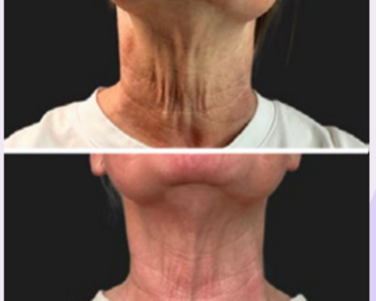 Polinucleotidos Plenhyage XL Stronge 2 ml