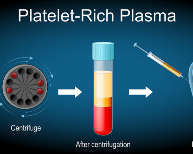Plasma Rico en Plaquetas 