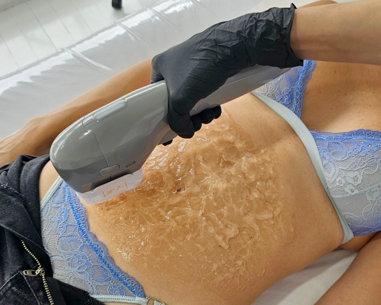 HIFU 7D ABDOMEN+FLANCOS+TIRA DE CORPIÑO