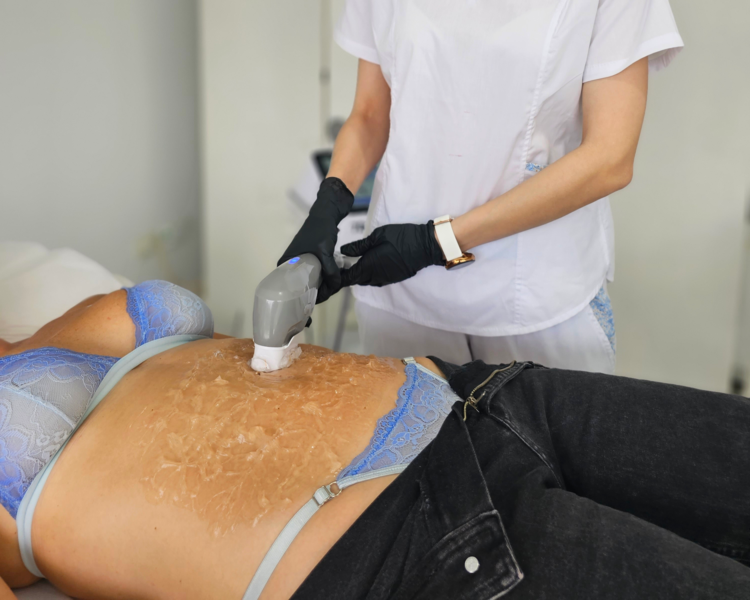 HIFU 7D TIRA DE CORPIÑO