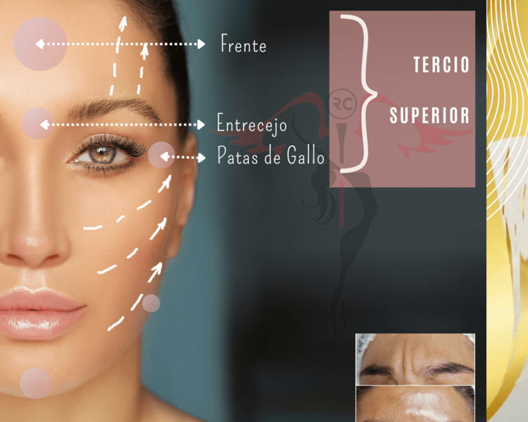 Botox tercio superior