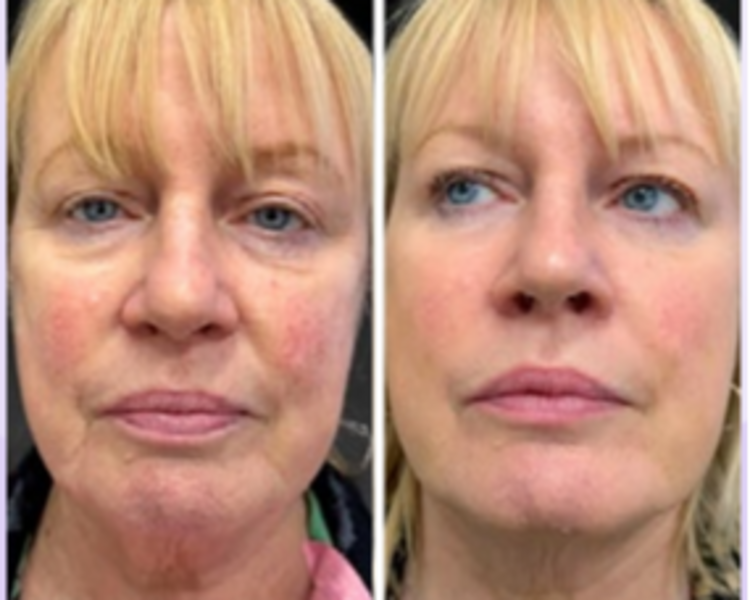 Polinucleotidos Plenhyage XL thin 2 ml