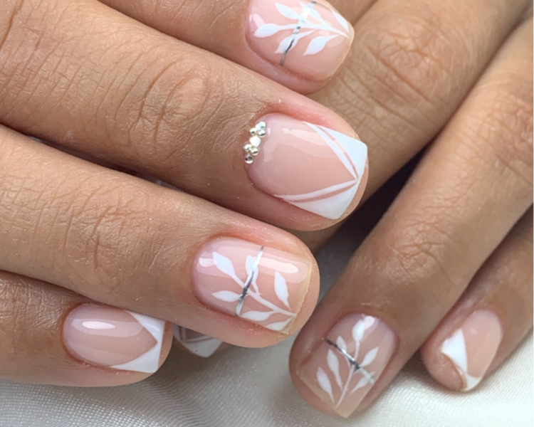 Kapping con nivelación o con limado