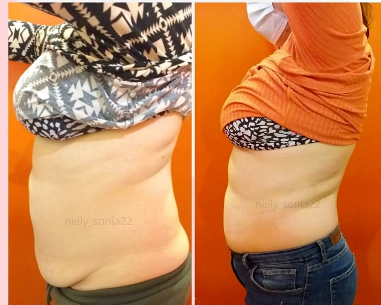 LIPOLASER CON ENDERMOTERAPIA