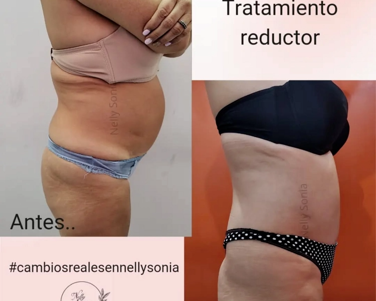 REDUCTOR MODELADOR COMBINADO