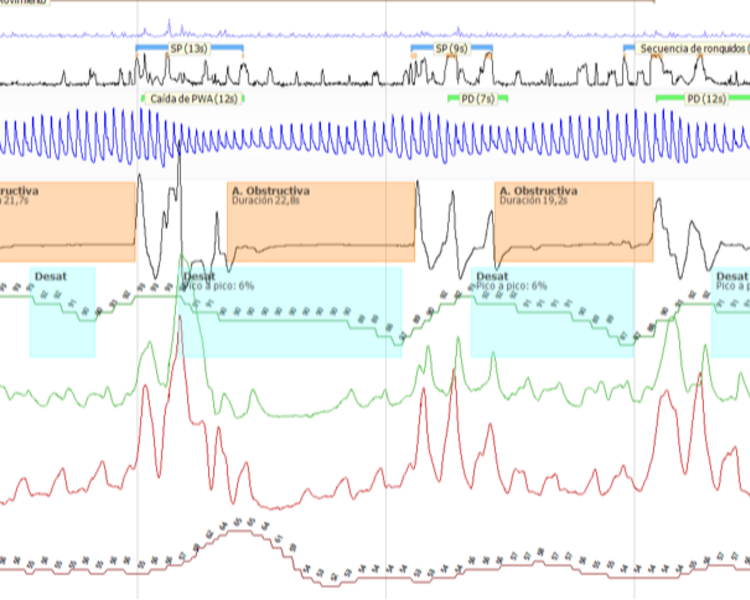 POLIGRAFÍA CARDIORESPIRATORIA DEL SUEÑO