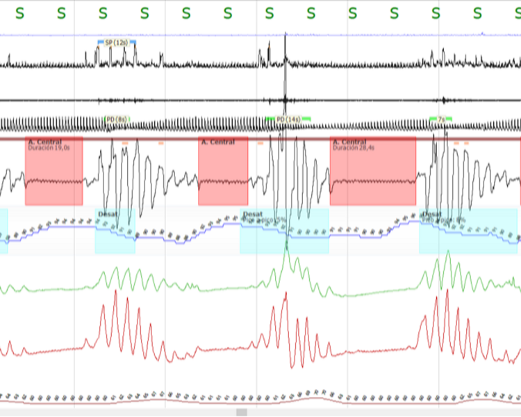 TITULACIÓN CON SERVOVENTILADOR