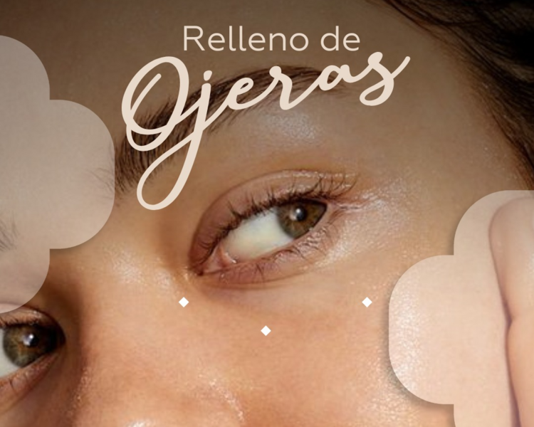 Relleno de Ojeras con Ácido Hialurónico