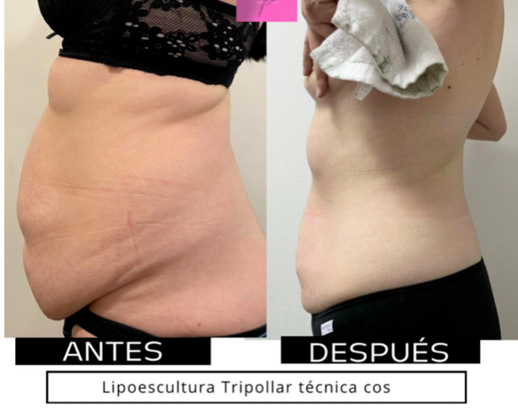 LIPOESCULTURA TRIPOLLAR 6 SESIONES