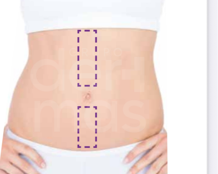 Depilación Línea Media de Abdomen