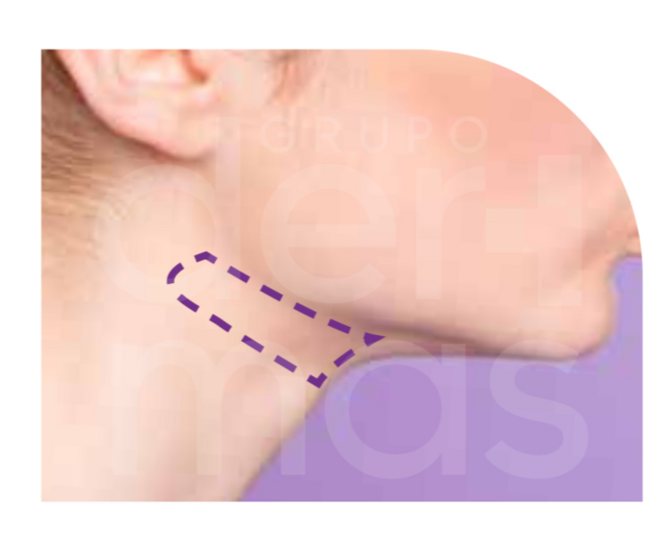 Extensión de Cuello