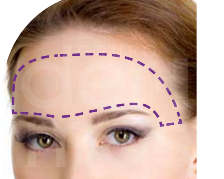 Depilación de Frente