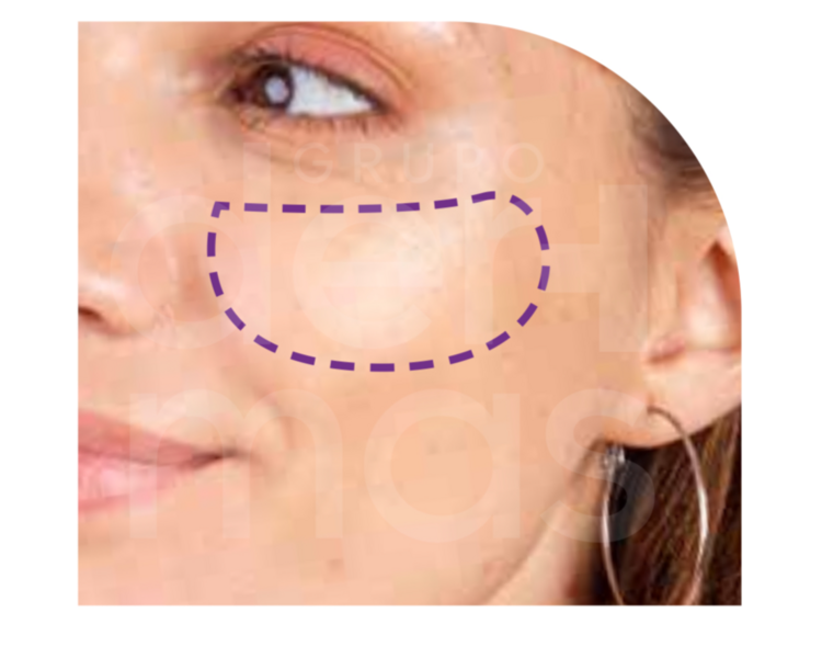 Depilación Mejillas