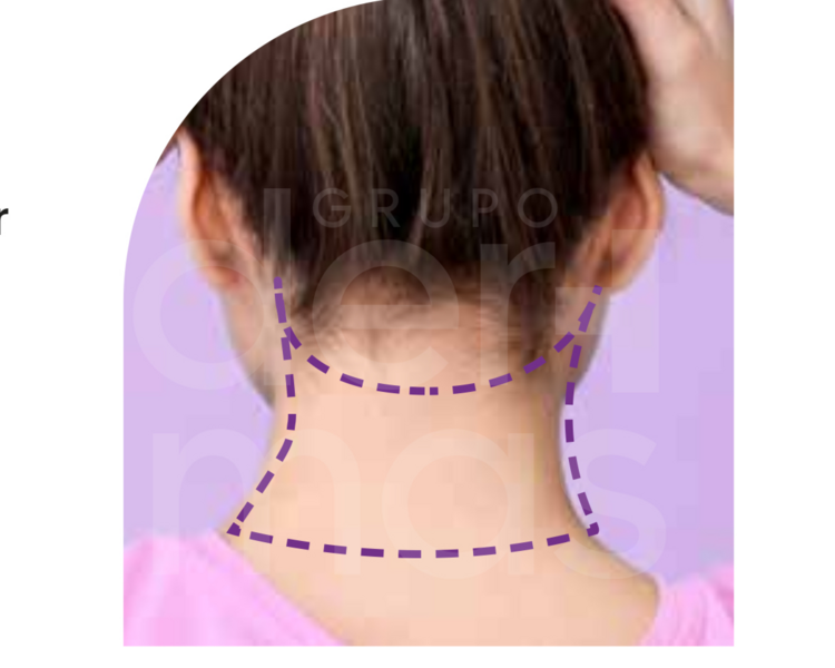 Depilación Nuca
