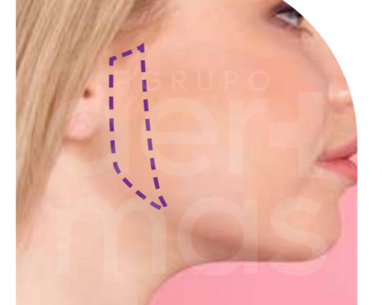 Depilación Patillas