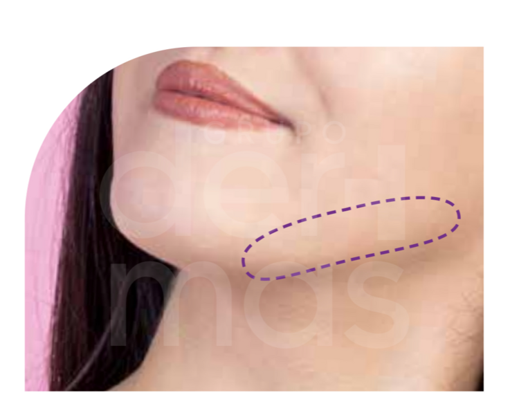 Depilación Mandíbula