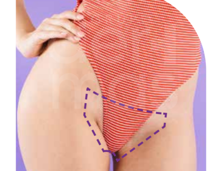 Depilación Bikini Delineado