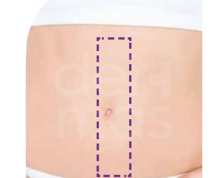 Depilación Línea de Abdomen Total