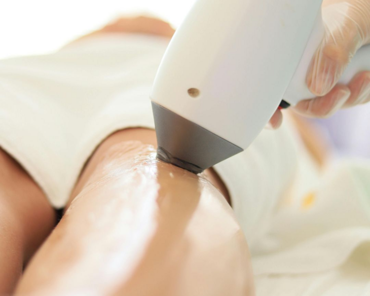 Depilación Láser Intimate . Bozo, axilas y piernas y rebaje completo